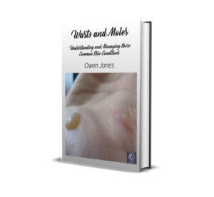 Understanding Warts and Moles 3 Warts and Moles mock-up